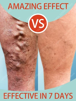 Krčnih Veno Zdravljenja Krema Učinkovito Lajšanje Noge Razširjene Vaskulitis Phlebitis Naravna Formula, Mazilo Za Krčne Žile